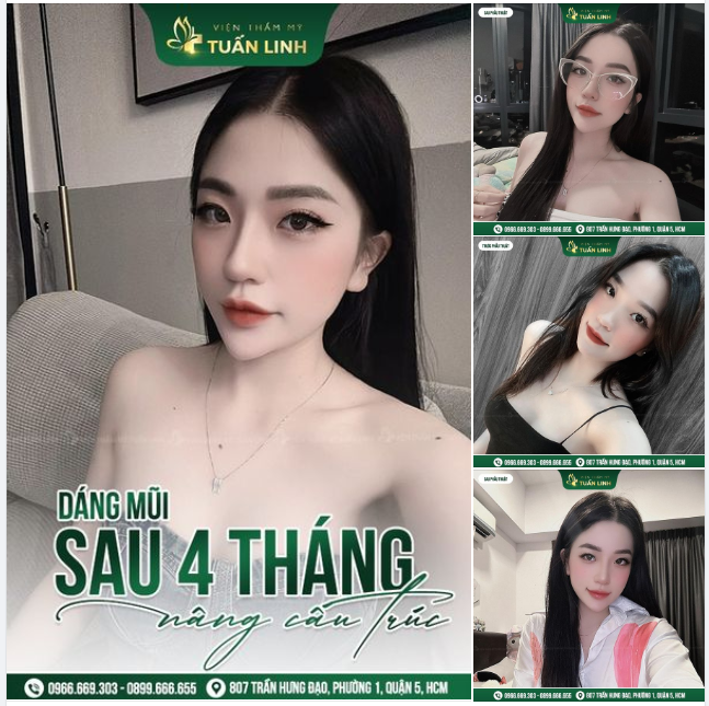 Hết thấp tẹt - Mũi cao sang đẹp chuẩn Hotgirl!!