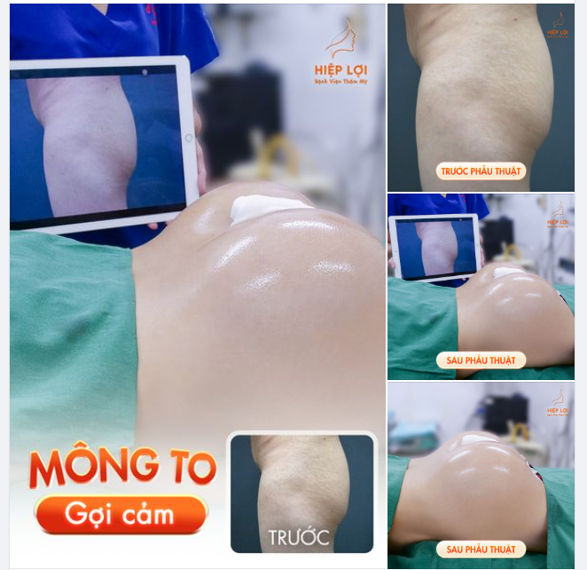 Kết quả sau 90 phút “độ mông” Tạm biệt nỗi lo mông lép, lõm hóp - Tăng size vòng 3 đầy đặn gợi cảm