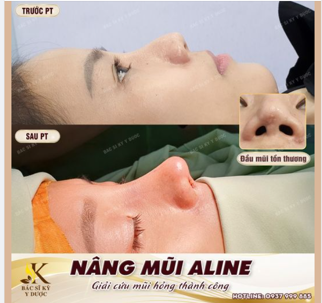NÂNG MŨI ALINE - PHƯƠNG PHÁP NÂNG CAO