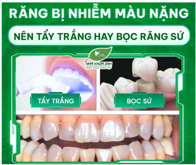 RĂNG BỊ NHIỄM MÀU NẶNG NÊN TẨY TRẮNG HAY BỌC SỨ