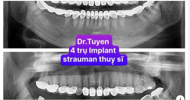 Tại sao mất một chiếc răng có thể ảnh hưởng đến toàn bộ hàm răng?