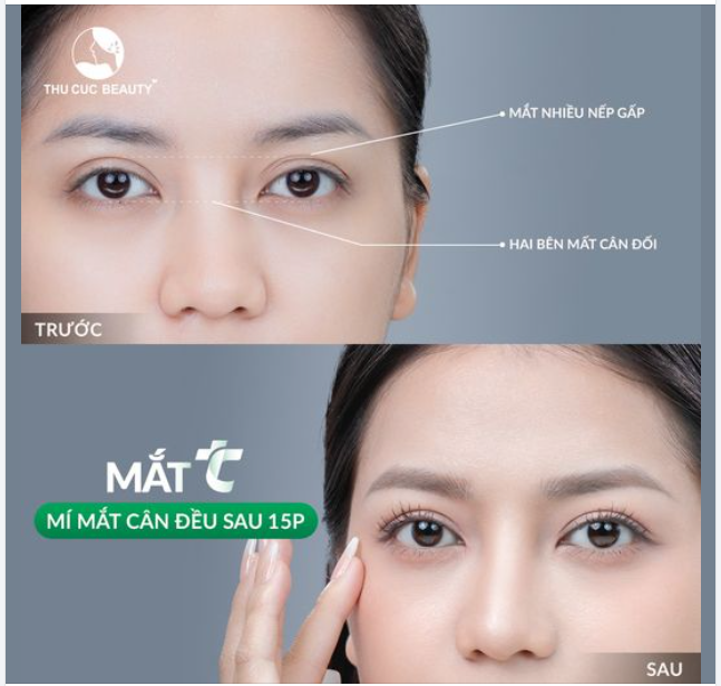 Cắt mí hợp lý - Tối ưu chi phí với ưu đãi Mắt TC giảm 35%