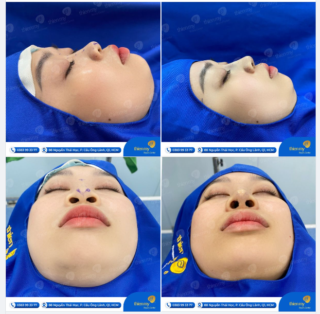 Chị em cùng chiêm ngưỡng dáng mũi nhẹ nhàng đang được nhiều chị em yêu thích nhất tại PKCK Thiện Mỹ