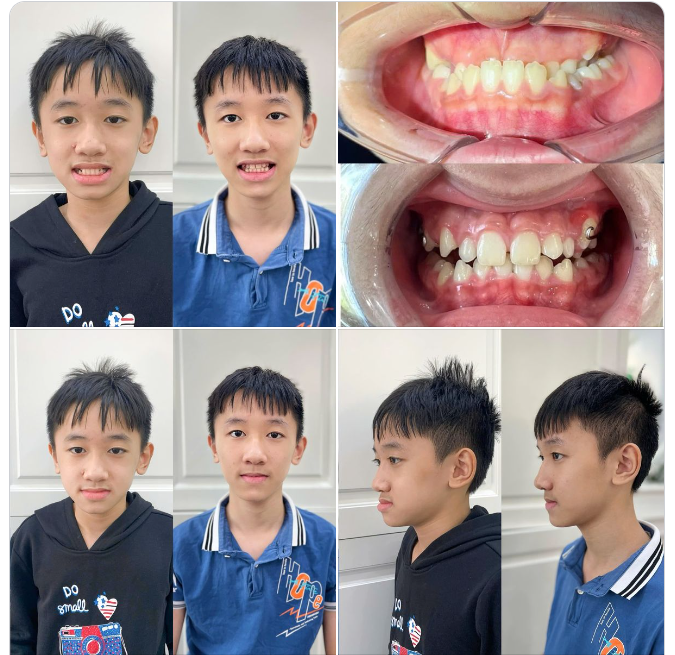 KHÔNG KHÓ ĐỂ GIÚP CON CÓ HÀM RĂNG ĐỀU ĐẸP NGAY TỪ KHI CÒN NHỎ