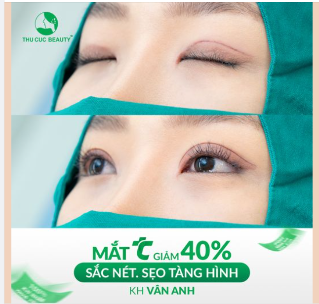 15P thực hiện. 3 ngày vào form. Sinh hoạt bình thường ngay sau khi phẫu thuật xong