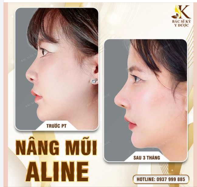 NÂNG MŨI ALINE - THAY ĐỔI VẬN MAY