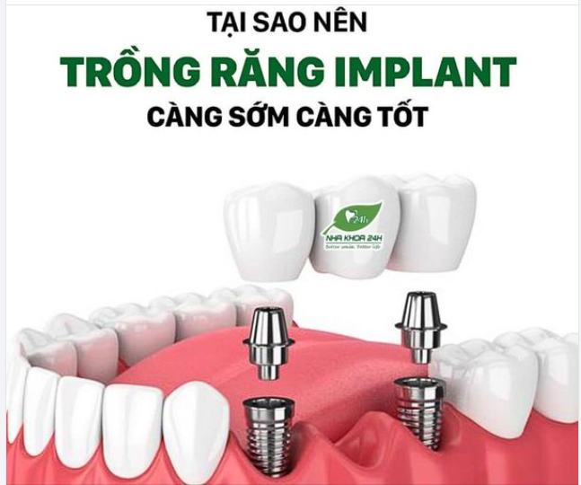 TẠI SAO NÊN TRỒNG RĂNG IMPLANT CÀNG SỚM CÀNG TỐT