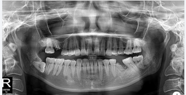 Trước khi nhổ răng khôn bạn cần làm gì