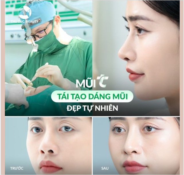 Không còn tự ti mũi hếch đã từng can thiệp làm mũi với ưu đãi Mũi TC chỉ từ 9.9Tr duy nhất trong 2 ngày 30-31/8