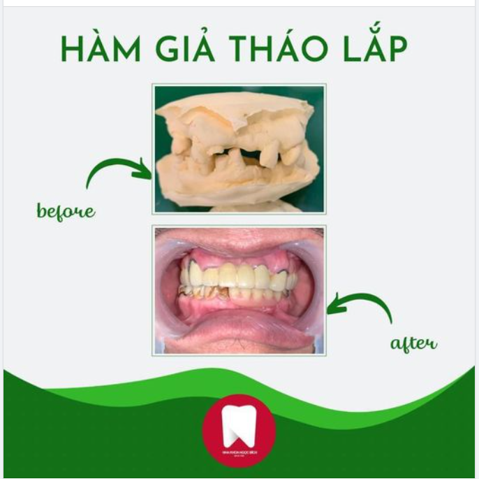 HÀM GIẢ THÁO LẮP, PHƯƠNG PHÁP PHỤC HÌNH RĂNG HƯ TỔN CHO NGƯỜI GIÀ