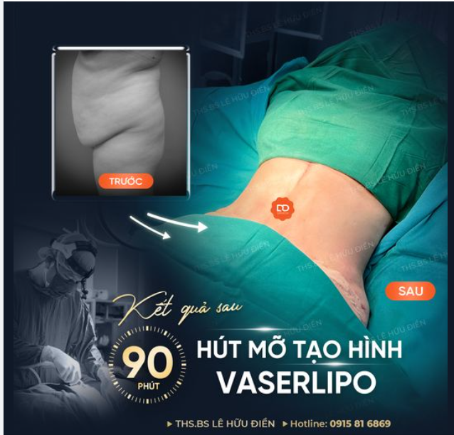 90 PHÚT HÚT MỠ TẠO HÌNH VASERLIPO CÓ NGAY BỤNG PHẲNG EO THON.