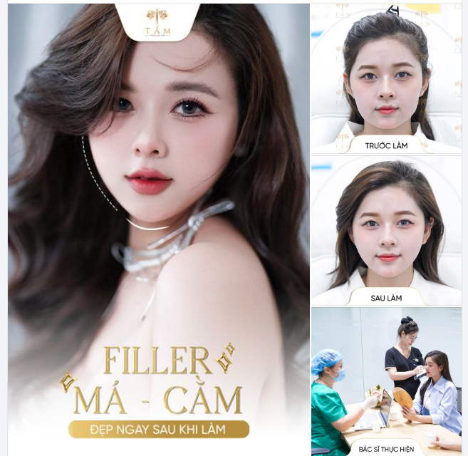 KẾT QUẢ SAU CÂN CHỈNH FILLER MÁ - CẰM