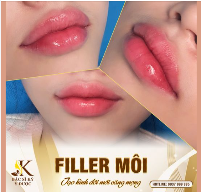 FILLER MÔI - TẠO HÌNH ĐÔI MÔI CĂNG MỌNG
