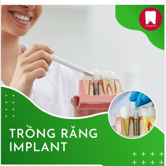 TRỒNG RĂNG IMPLANT - GIẢI PHÁP PHỤC HÌNH RĂNG MẤT HOÀN HẢO CỦA NGƯỜI HIỆN ĐẠI