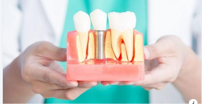9 lợi ích của việc cấy ghép Implant
