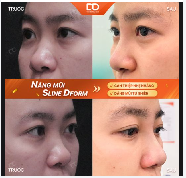 TẠO SỨC HÚT VỚI DÁNG MŨI CAO TỰ NHIÊN.