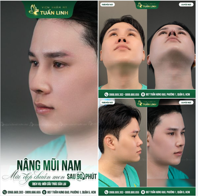 U mê trước dáng mũi đẹp tinh tế đến từng chi tiết chỉ sau 90 phút phẫu thuật của khách hàng nhà Tuấn Linh!