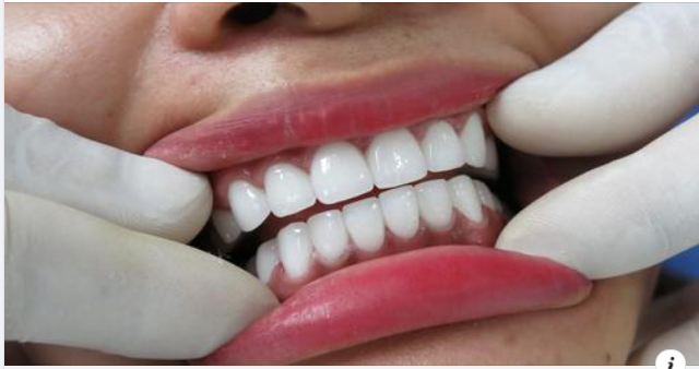 Cảm giác sau khi bọc răng sứ: Những điều bất thường cần lưu ý