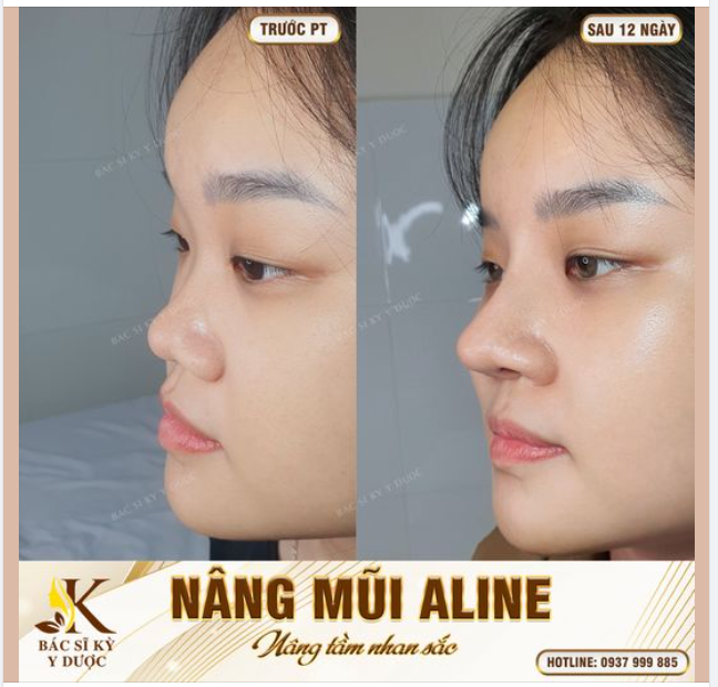 DÁNG MŨI ALINE SAU 12 NGÀY THỰC HIỆN