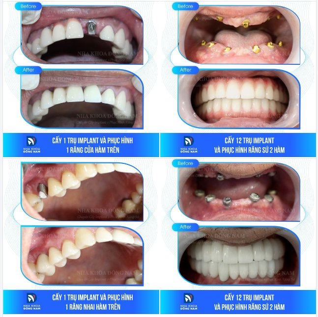 Mất răng không chỉ đơn thuần là mất đi một chiếc răng, nó còn là nỗi ám ảnh của nhiều người.