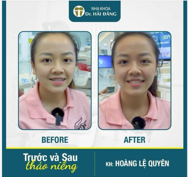 CHÚC MỪNG BẠN LỆ QUYÊN ĐÃ THÁO MẮC CÀI VỚI NỤ CƯỜI TỰ TIN