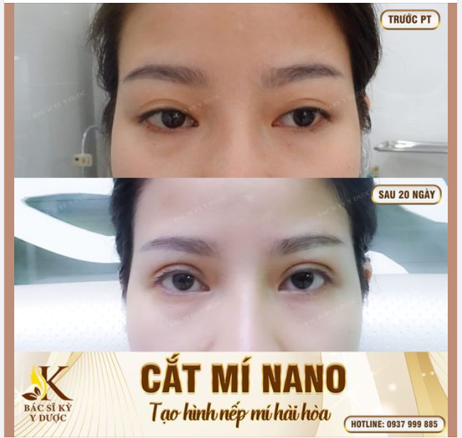 CẮT MÍ NANO BAO LÂU THÌ ĐẸP?