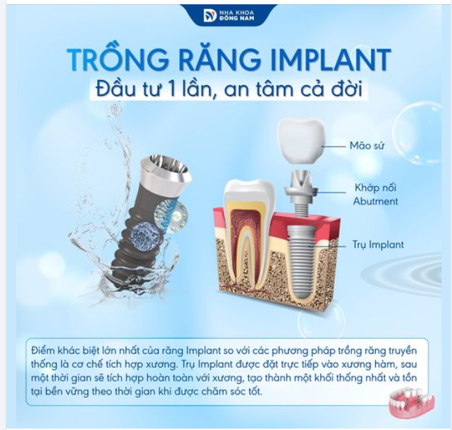 Implant không chỉ là răng giả mà còn là một phần của cơ thể.
