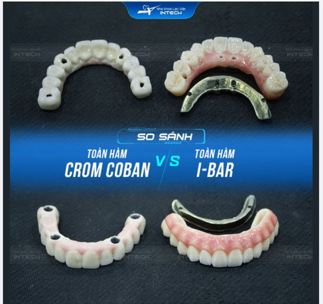 4 ƯU ĐIỂM NỔI BẬT CỦA TOÀN HÀM I-BAR SO VỚI TOÀN HÀM CROM COBAN KHI TRỒNG RĂNG IMPLANT TOÀN HÀM