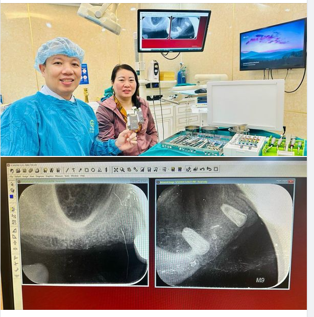TRỒNG RĂNG IMPLANT- GIẢI PHÁP NỤ CƯỜI HOÀN HẢO