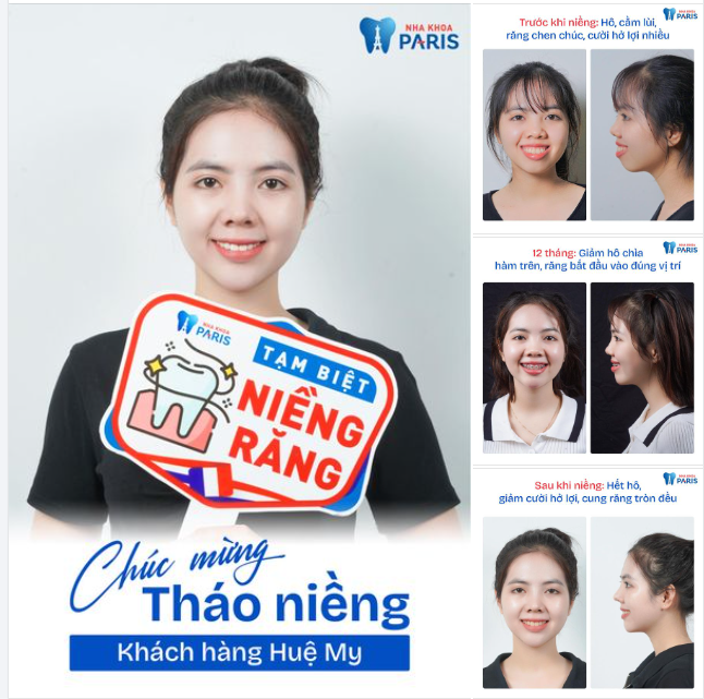 NIỀNG RĂNG ĐẸP CỠ NÀO?