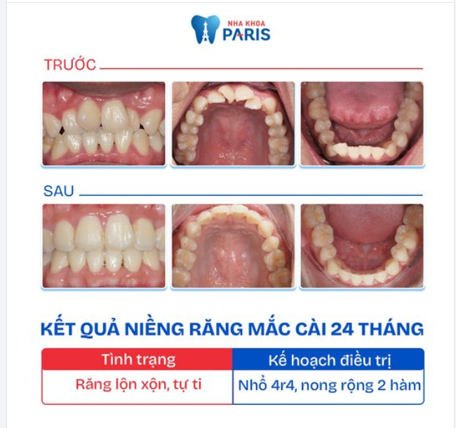 CUNG RĂNG TRÒN ĐỀU - KHỚP CẮN CHUẨN CHỈ SAU 24 THÁNG NIỀNG