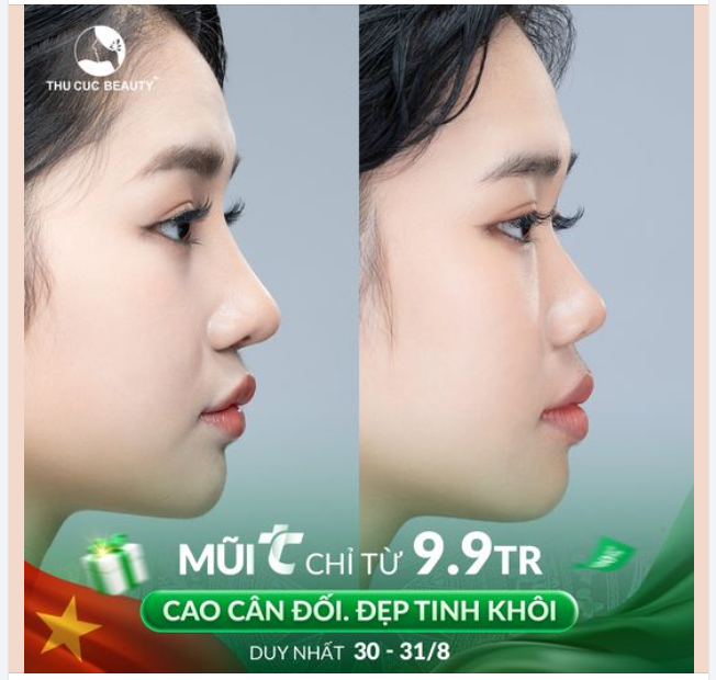 Nâng mũi đẹp ngay kịp đón lễ chỉ từ 9.9TR cho khách hàng TC