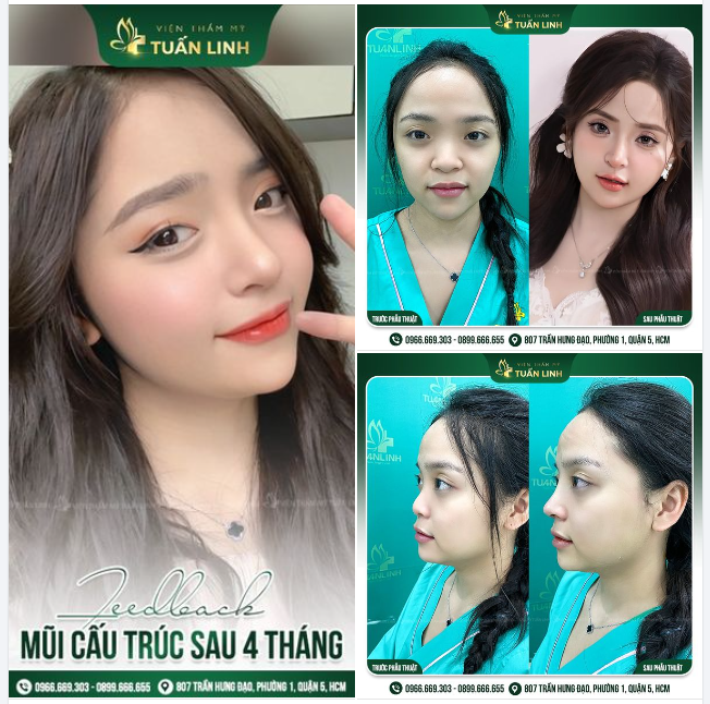 DÁNG MŨI SAU 4 THÁNG - TRẺ TRUNG, SANG CHẢNH, THẦN THÁI “NGÚT NGÀN”!!