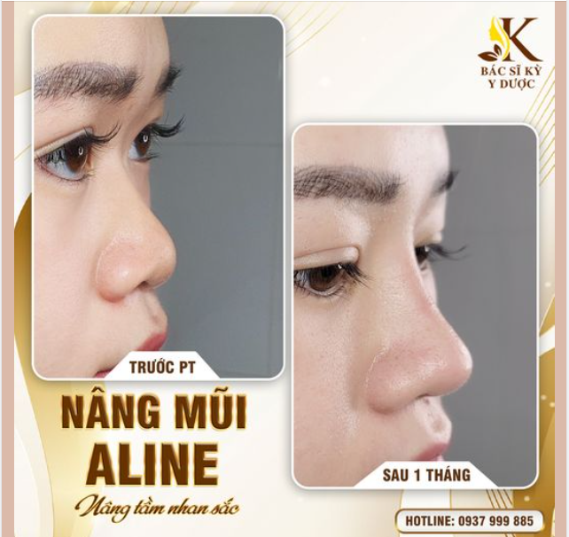 Trở nên tự tin hơn với dáng mũi đẹp không tì vết