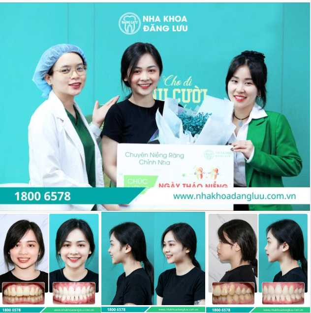 RĂNG XINH RỒI, THÁO NIỀNG THÔI!