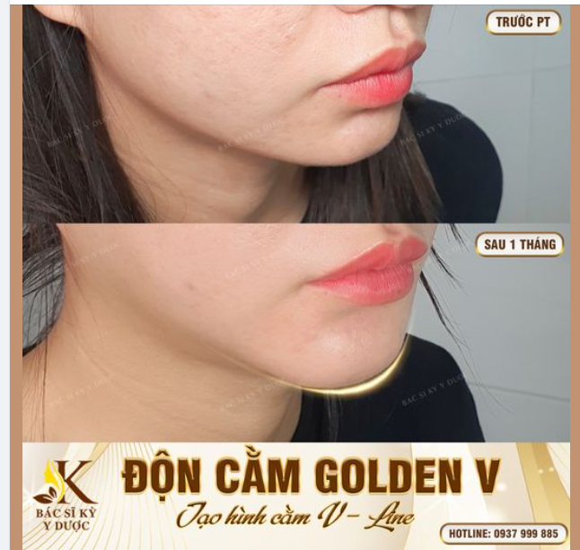 Nhiều bạn nhận xét trông em xinh hơn nhưng lại không biết em đã thay đổi là nhờ ĐỘN CẰM GOLDEN - V