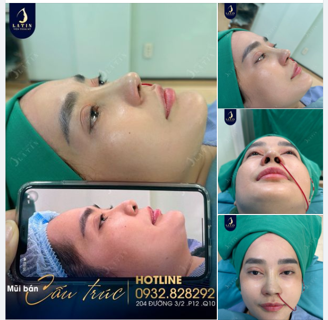 Mũi bán cấu trúc cao nét tự nhiên cho chị gái đến từ Bến Tre