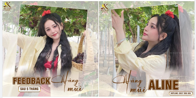 UPDATE PHIÊN BẢN HOÀN HẢO NHỜ NÂNG MŨI ALINE