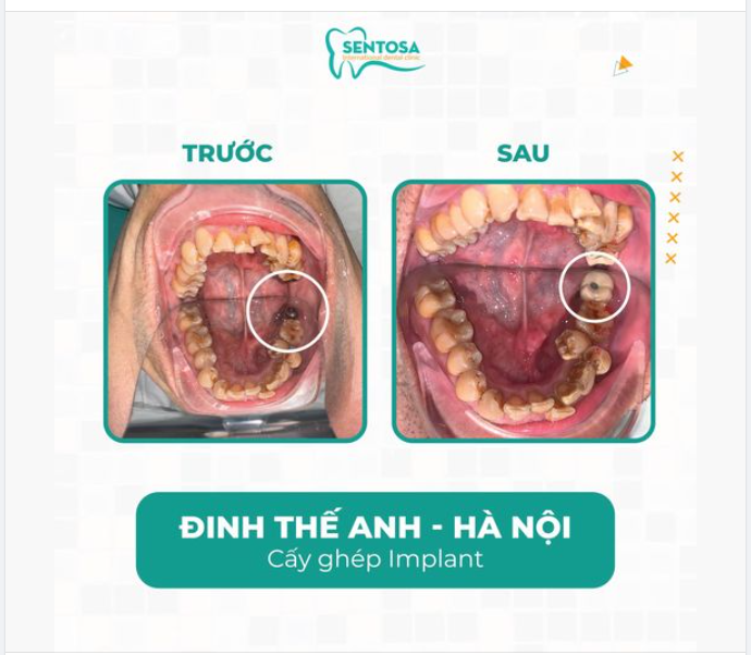 CẮM IMPLANT KHÔNG ĐỢI TUỔI!!!