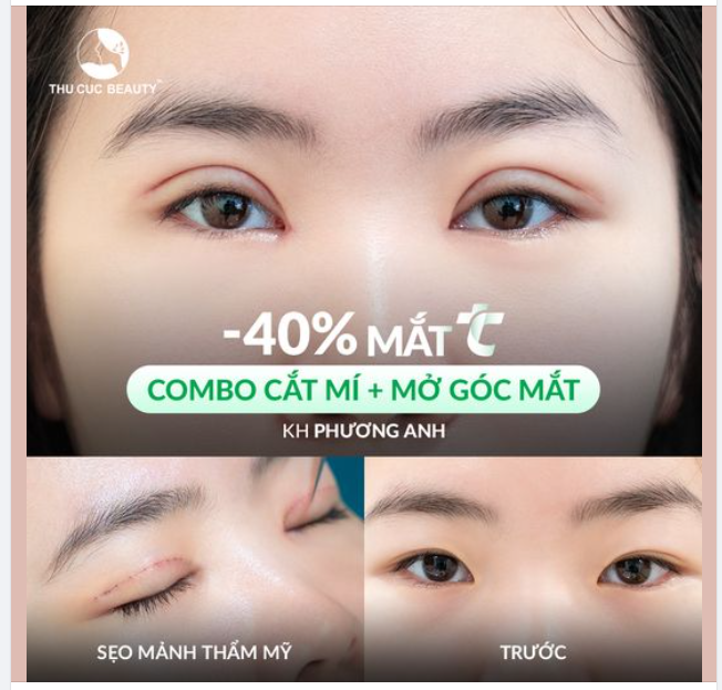 15P sở hữu nếp mí tự nhiên. Gửi ảnh tình trạng mí hiện tại nhận tư vấn ngay