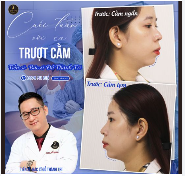 Cuối tuần với ca Trượt cằm cho cô gái có cằm ngắn lẹm
