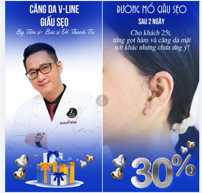 Khách hàng 25t, từng gọt hàm và căng da mặt nơi khác, tuy nhiên kết quả không như mong muốn.