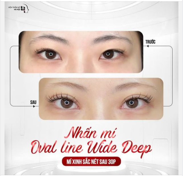 NHẤN MÍ OVAL LINE WIDE DEEP - MÍ XINH SẮC NÉT