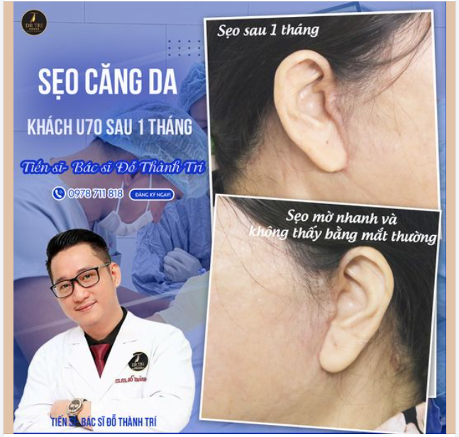 HÌNH MỘC cận cảnh sẹo biến mờ nhanh, khó thấy bằng mắt thường sau 1 tháng Căng da VLine giấu sẹo