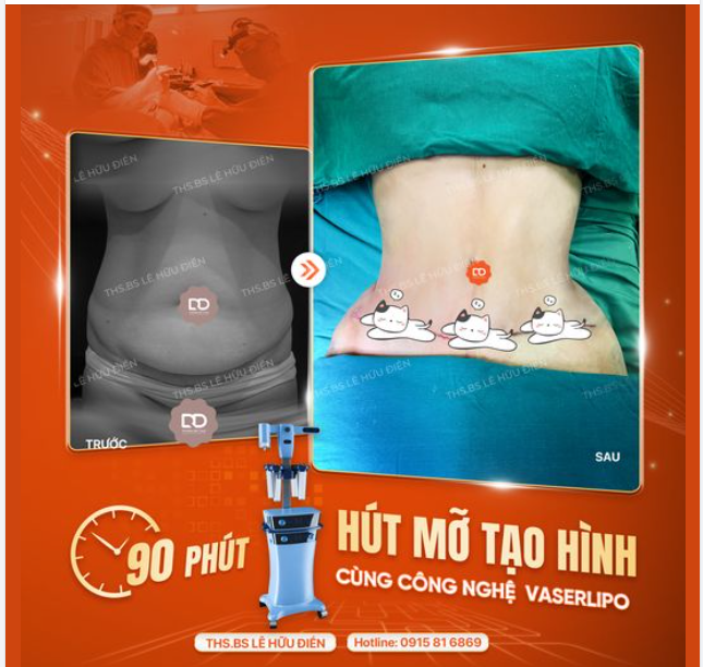90 PHÚT HÚT MỠ TẠO HÌNH CÙNG CÔNG NGHỆ VASERLIPO