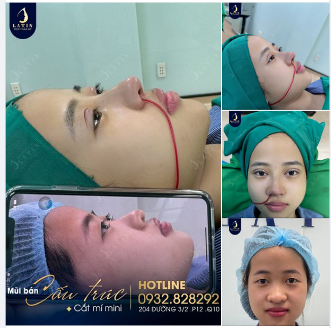 Biến hình mắt một mí, mũi tẹt cho em gái