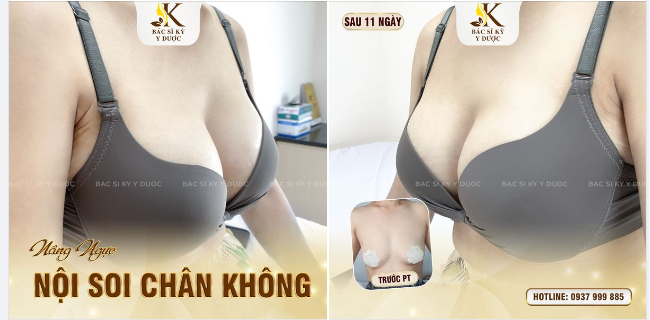NGÀY XƯA ANH CHÊ TÔI “LÉP”