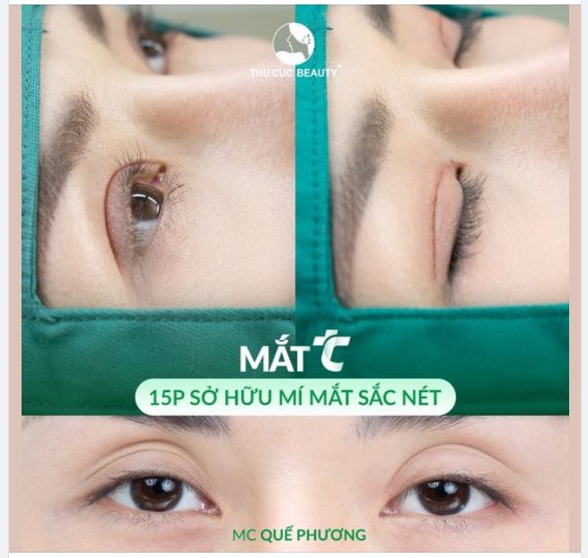 Cắt mí chuẩn từng li Lựa chọn Mắt TC