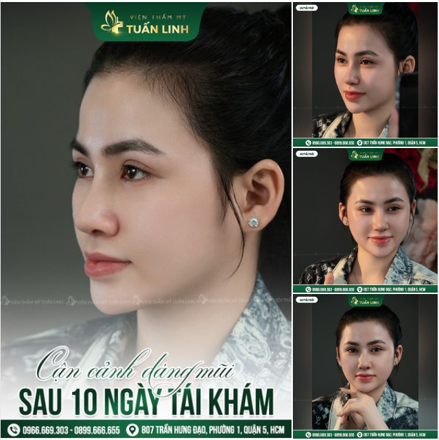 NÂNG CẤP MŨI CẤU TRÚC VÀ KẾT QUẢ SAU 10 NGÀY QUÁ XỨNG ĐÁNG!!