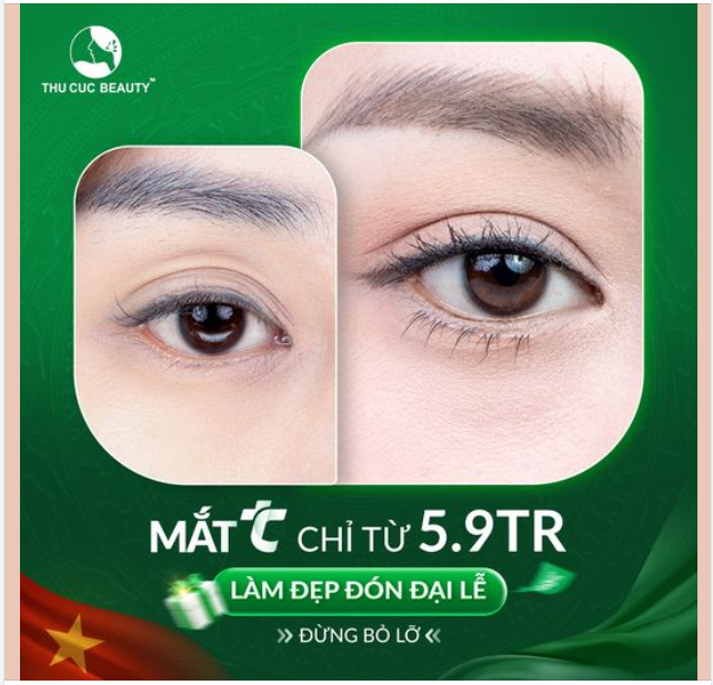 Cắt mí đón Đại Lễ